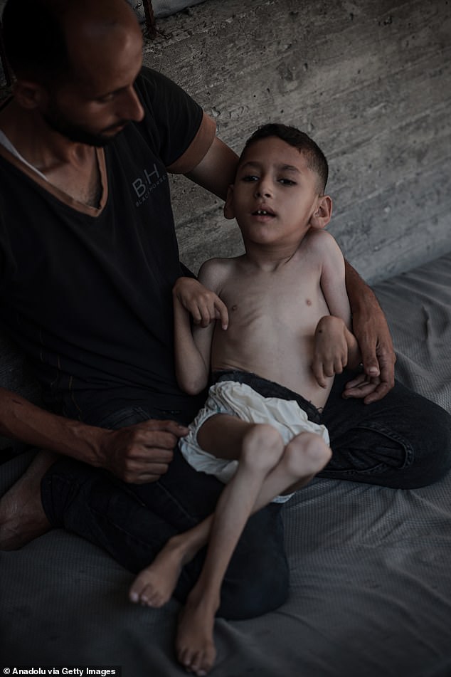 Six-year-old Malik Nidal Saad suffers from severe malnutrition in a tent in western Gaza, where he took shelter with his family after fleeing Beit Lahia