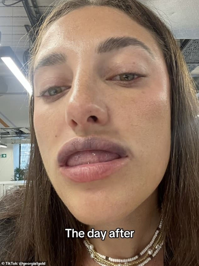 Georgia still went to work the day after getting her lip filler dissolved, despite the bruising and swelling