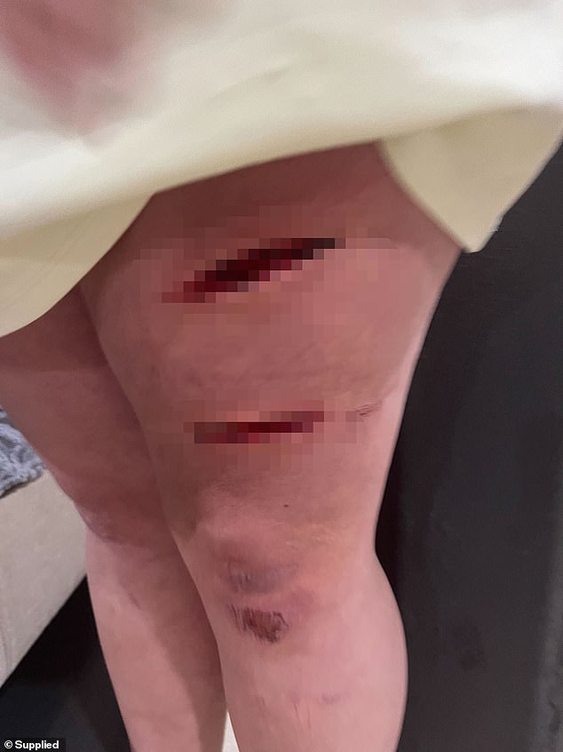 After Rebecca and her husband terminated the au pair's employment, she self-harmed in her room with knives (her injuries are shown) and was later sectioned under the Mental Health Act