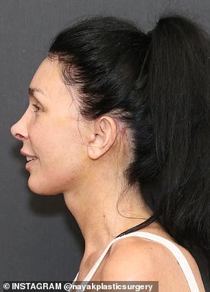 Kelly, 56, after undergoing a series of facial rejuvenation procedures with Dr. Mike Nayak