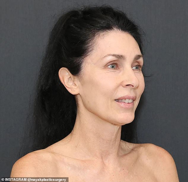 Kelly, a longtime staff member at Nayak Plastic Surgery, underwent surgery in June ahead of her son's wedding (before surgery)