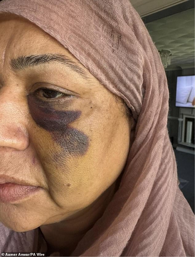 A picture showing an injury received by Shameem Akhtar, the mother of the brothers