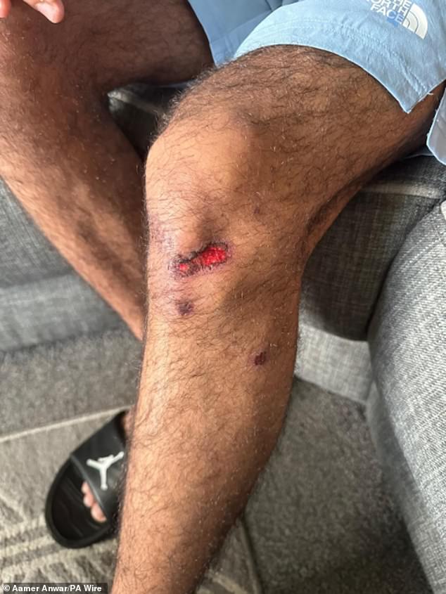 Pictured: An injury said to have been sustained by Mohammed Fahir Amaaz