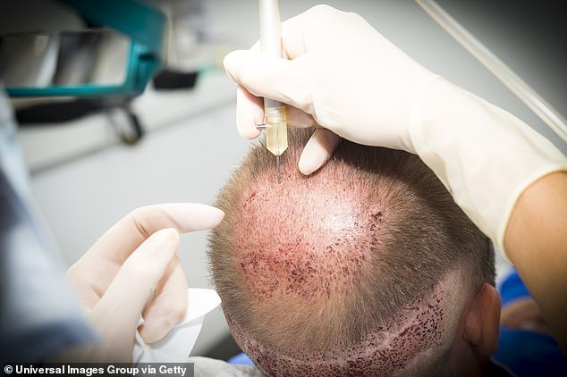 Shortly after the surgery, the Brit became unwell and was rushed to a nearby hospital for treatment. Pictured: Stock image of a male patient receiving a hair transplant
