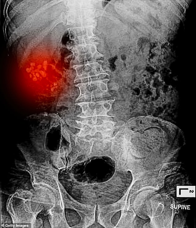 I had undergone a routine procedure to solve a routine problem (kidney stone, agony – avoid!), and since it had plainly been a total success I was bursting with gratitude to the doctors, nurses, staff, anyone involved in restoring me to health, writes Boris Johnson