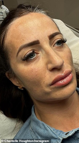 Chantelle Houghton has revealed her stunning transformation after undergoing an 'instant' liquid facelift