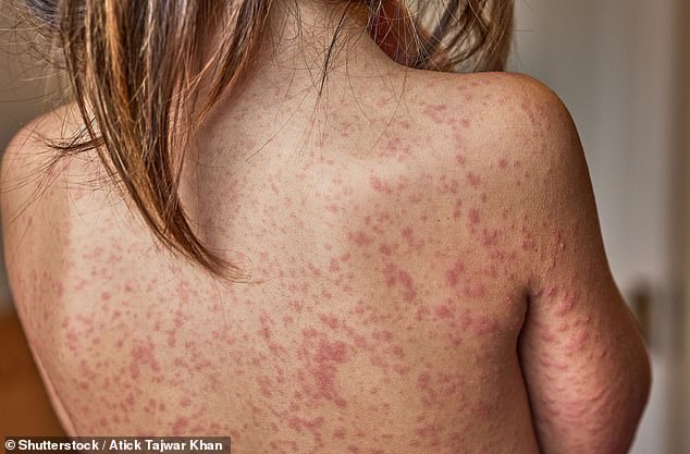 A child has died in hospital after contracting measles - marking the second death due to an acute infection of the disease in Britain this decade (Stock photo)