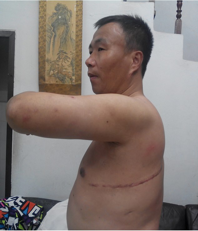Cheng Pei Ming, a victim of forced organ donation displays his scars after escaping China