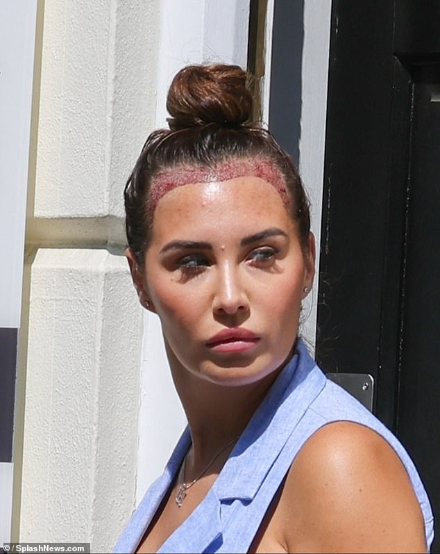 Chloe Goodman showed the shocking results of her hair transplant as the star was seen leaving the clinic in Kent on Wednesday