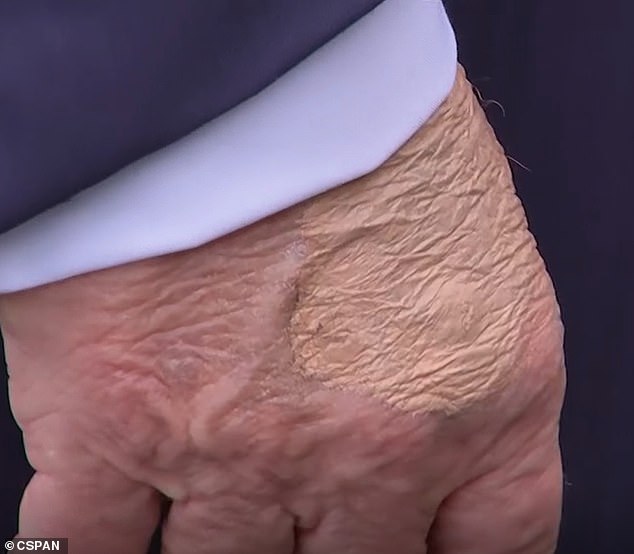 The makeup appeared to be covering a circular protrusion of skin that doctors told DailyMail.com was most likely the after-effect of a routine blood draw