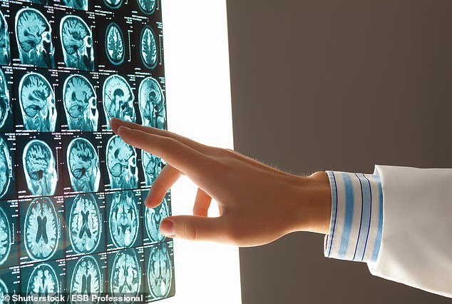 US scientists, who tracked almost 3,000 elderly adults with hearing loss, found almost a third of all dementia cases could be attributed to the issue