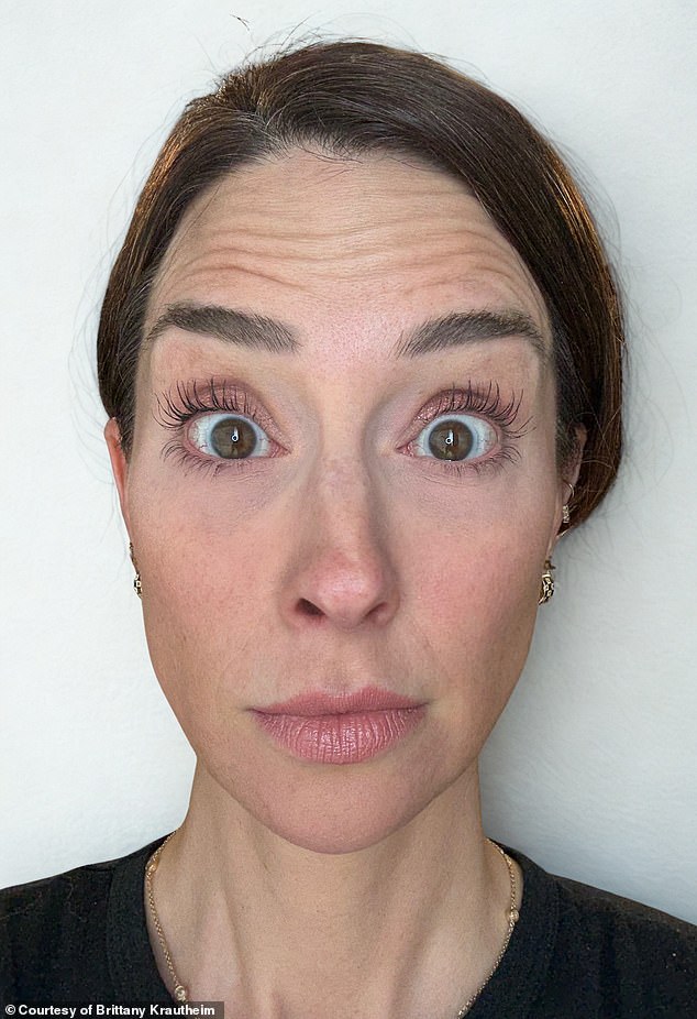 A nurse who got Botox injected on only one side of her face to show others how it really affects your looks has revealed the shocking results. She's seen before getting the Botox