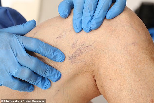 Also known as spider veins, thread veins are small blood vessels that appear on the skin and often look like webs or branches