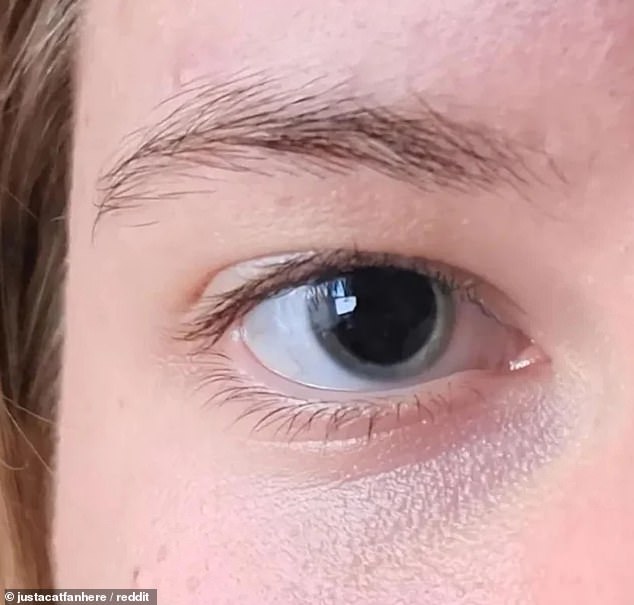 The young woman uploaded a picture to the 'Eyes' subreddit under the heading 'Why are my eyes so dilated?'