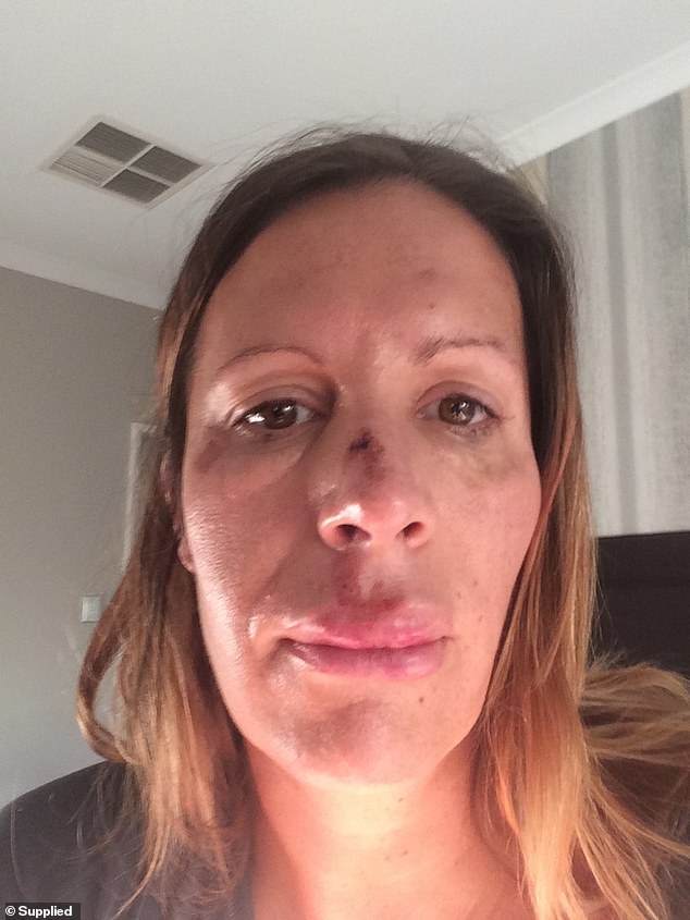 At a friend's 40th after a few too many drinks, Sarah was outside having a cigarette when she lost her balance and fell face first onto the concrete. She was left with a bruised face and split lip (pictured)