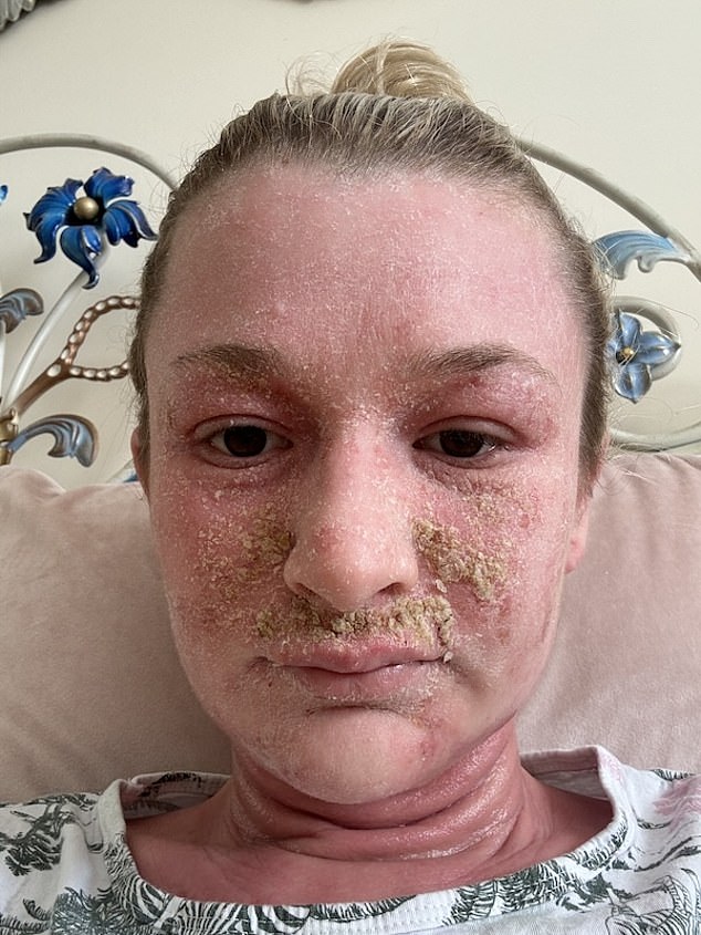 ‘The raw skin on my face, limbs and body was breaking down, weeping and peeling,’ says Chloe Tatton, who was experiencing topical steroid withdrawal (TSW), which can occur after people stop taking corticosteroid creams after prolonged use