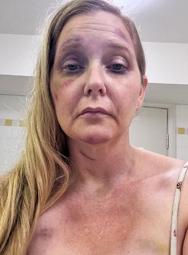Fresh pictures have emerged of sex trafficking victim Virginia Giuffre in hospital with serious facial injuries months before she took her own life in Western Australia