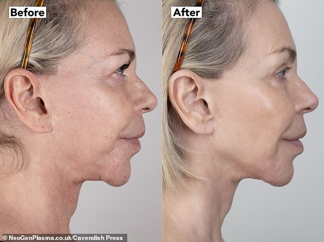 Leslie Ash, 65, has opened up about doing a £4,500 non-surgical face-lift that made her look 'ten years younger'