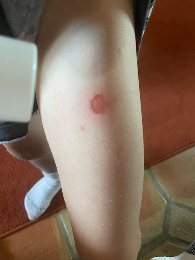 The burn left on Harry Warren's leg by a boiling Ryanair spaghetti bolognese