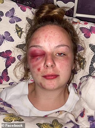 The injuries - which caused an outcry in her hometown of Barrow - turned out to be self-inflicted