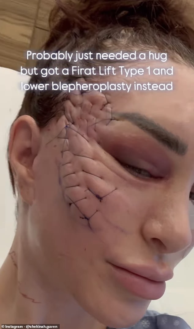 While the technique is said to promote better healing than a traditional facelift, in the immediate aftermath, patients are left with large stitches (pictured: Shekinah Garner)
