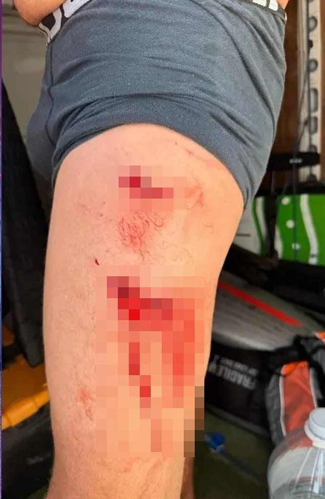 Although he was able to fight off the shark, the man sustained two gruesome bites just below his knees