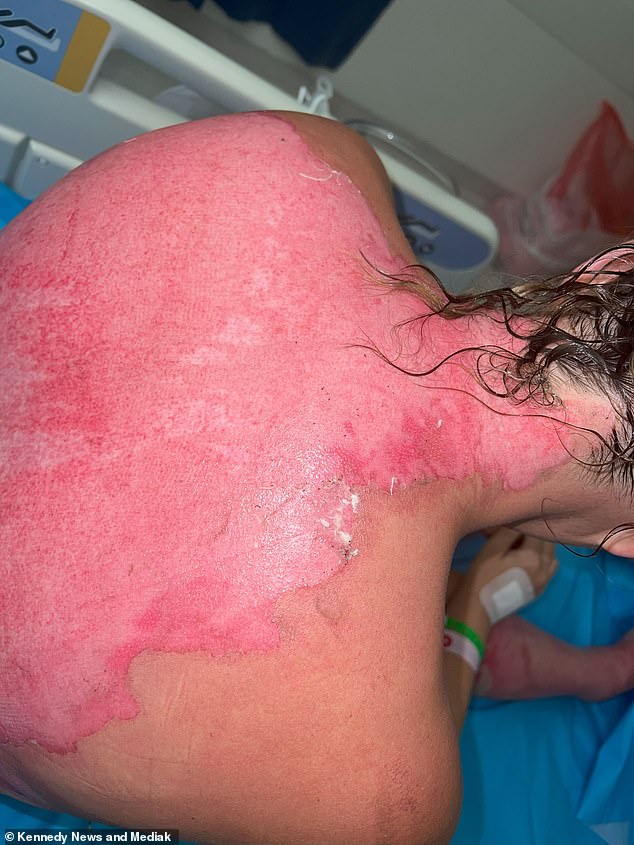 Emma was left with blistering third-degree burns after a freak gust of wind saw her engulfed in flames as her husband attempted to light their fire pit