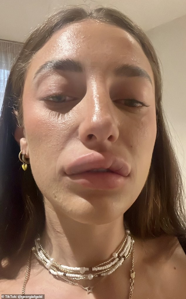 Georgia Goldstein (pictured) from London has revealed what happened when she had her lip filler dissolved - and admitted that she was left looking 'botched'