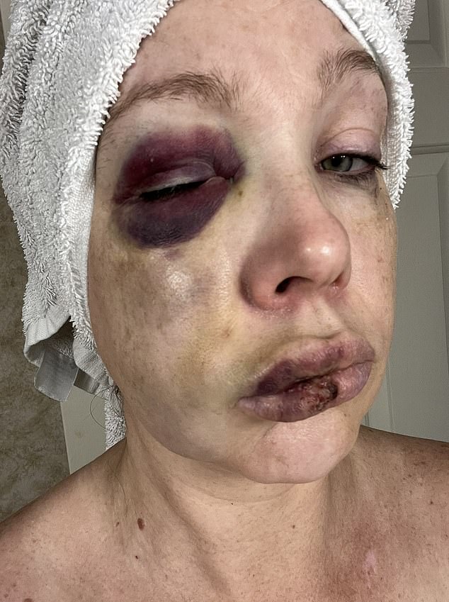 Images had emerged earlier this week of her extensive injuries with both sides of her face were extremely bruised following the assault