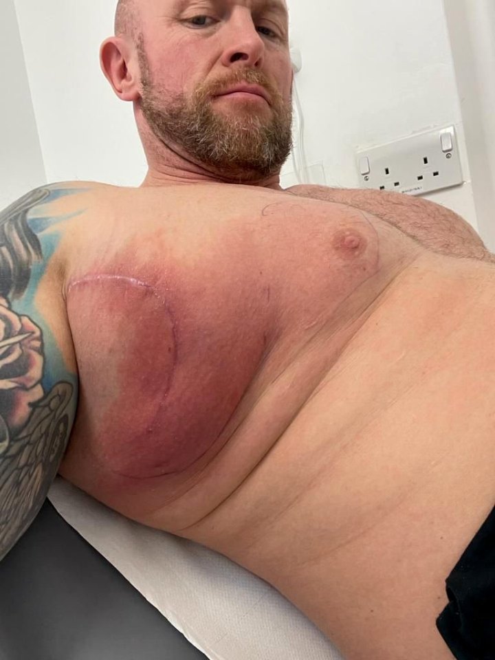 Photograph of Mickey Higham's chest showing a scar and swelling from cancer surgery.