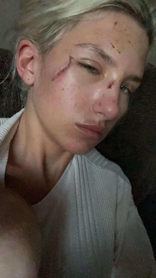 Close-up of a woman's face showing facial injuries.