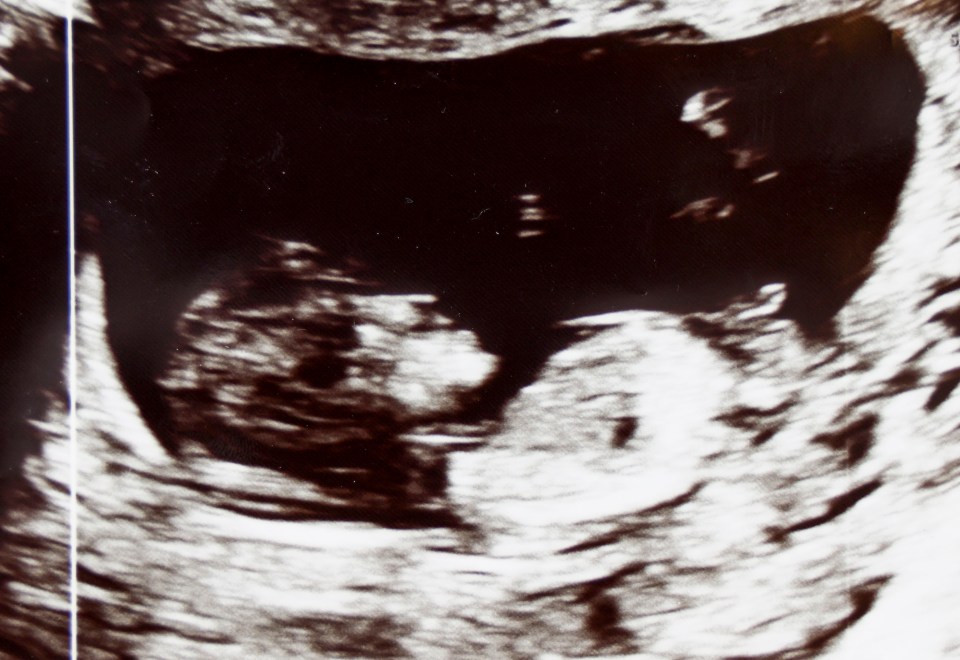 Ultrasound image of a baby.
