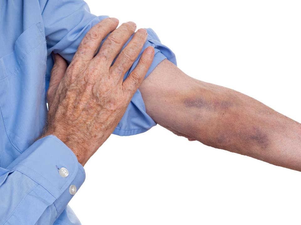 Bruising on an older person's arm after a blood test.