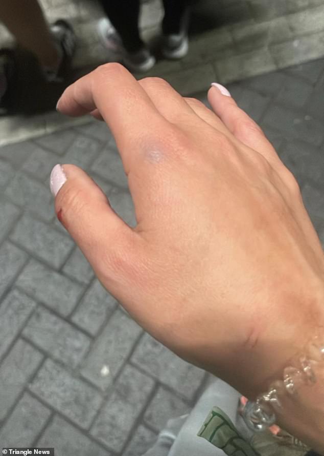 She has several cuts to her hands as well as large bruises on her legs