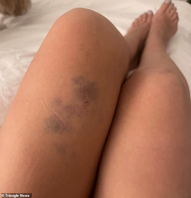 She has several cuts to her hands as well as large bruises on her legs