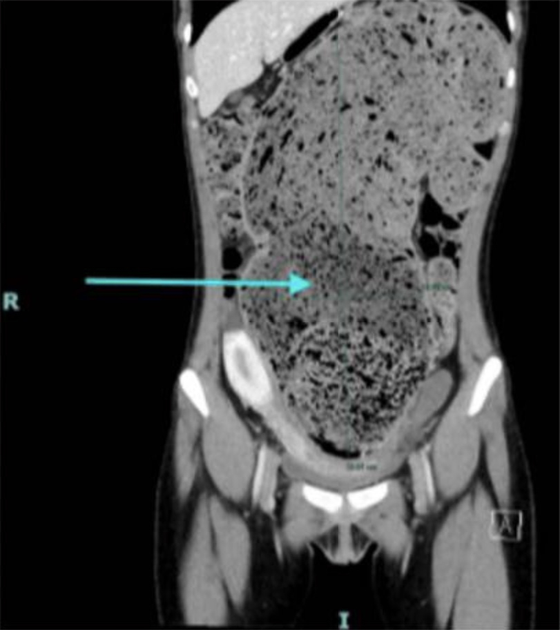 CT scan showing massively distended colon.