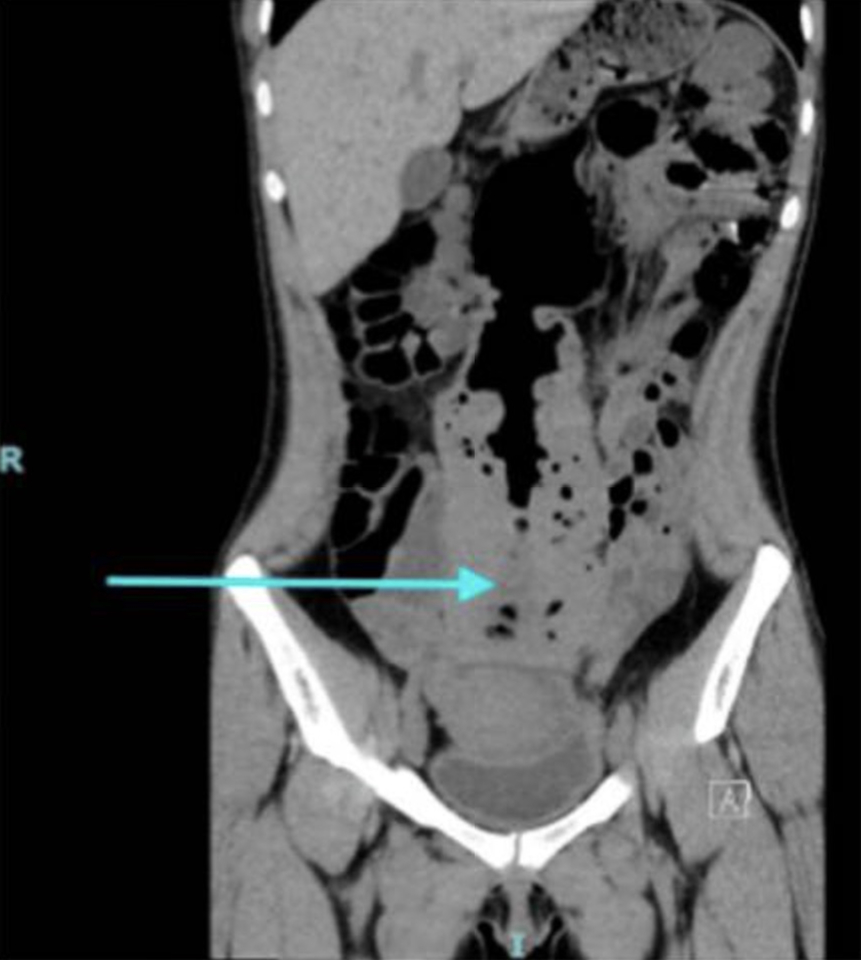 CT scan showing massively distended colon.