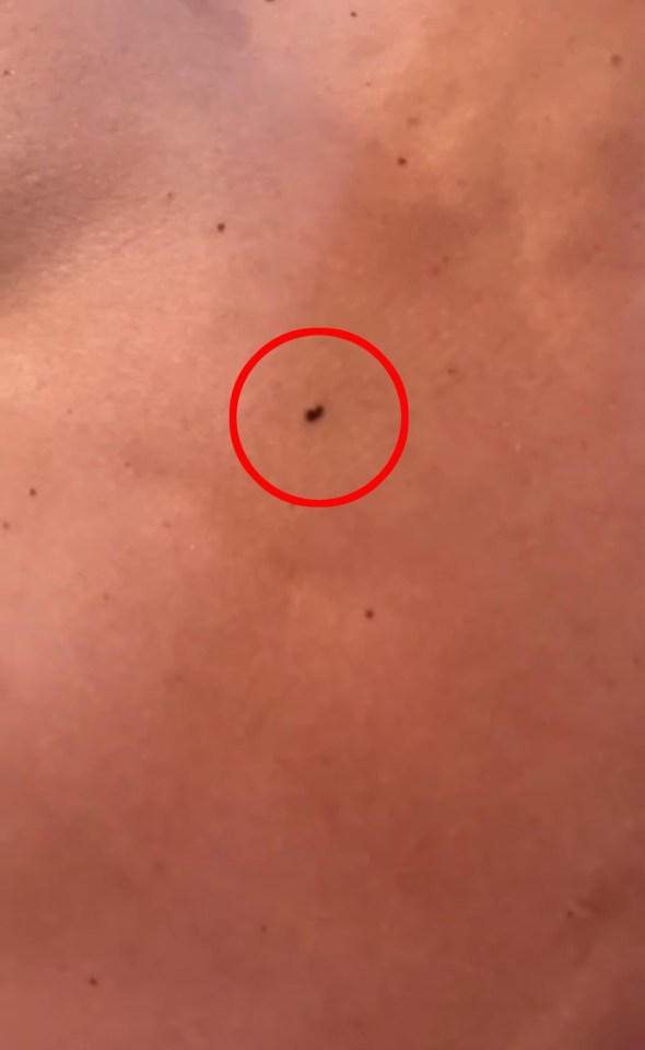 Close-up of mole circled on skin.