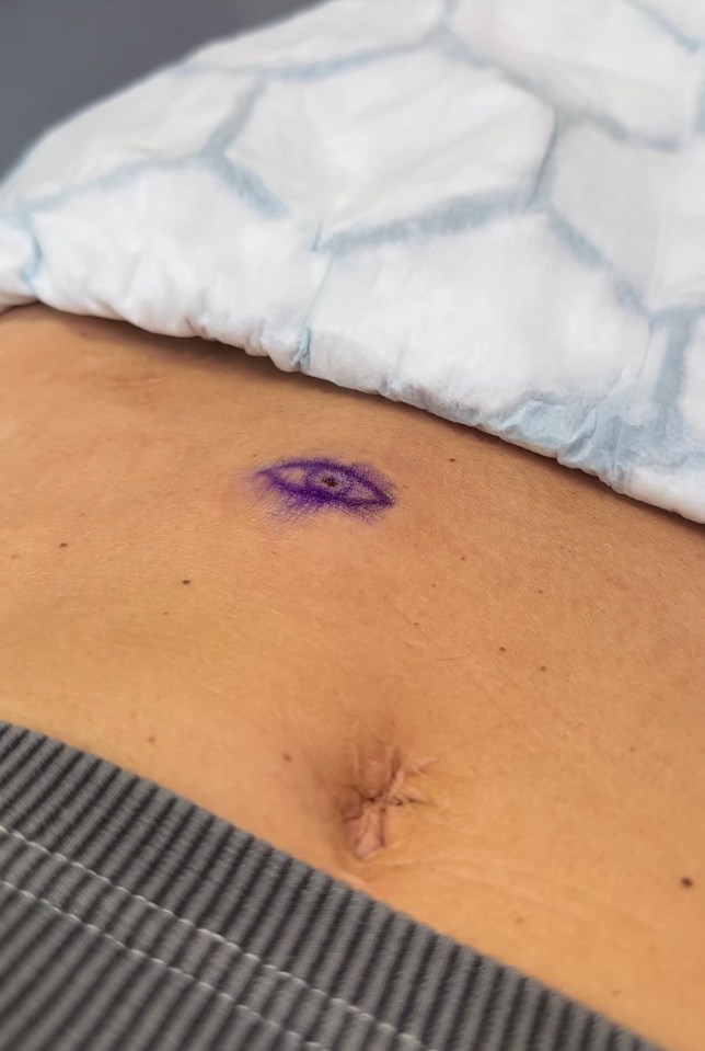Close-up of a patient's abdomen showing a purple marking for surgery.