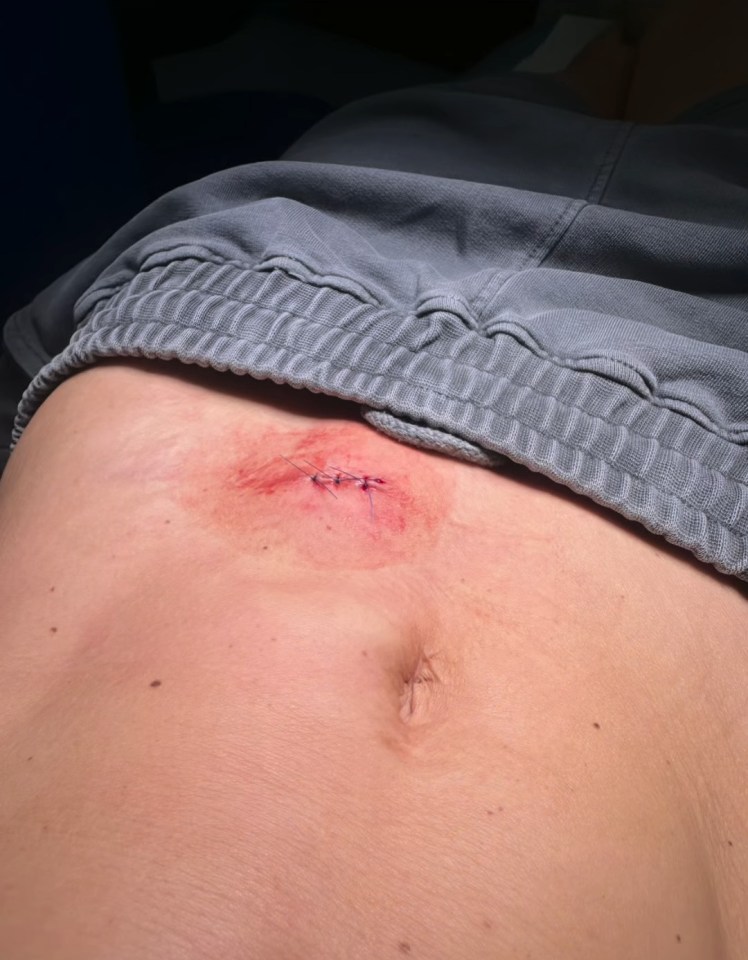 Close-up of a surgical incision.