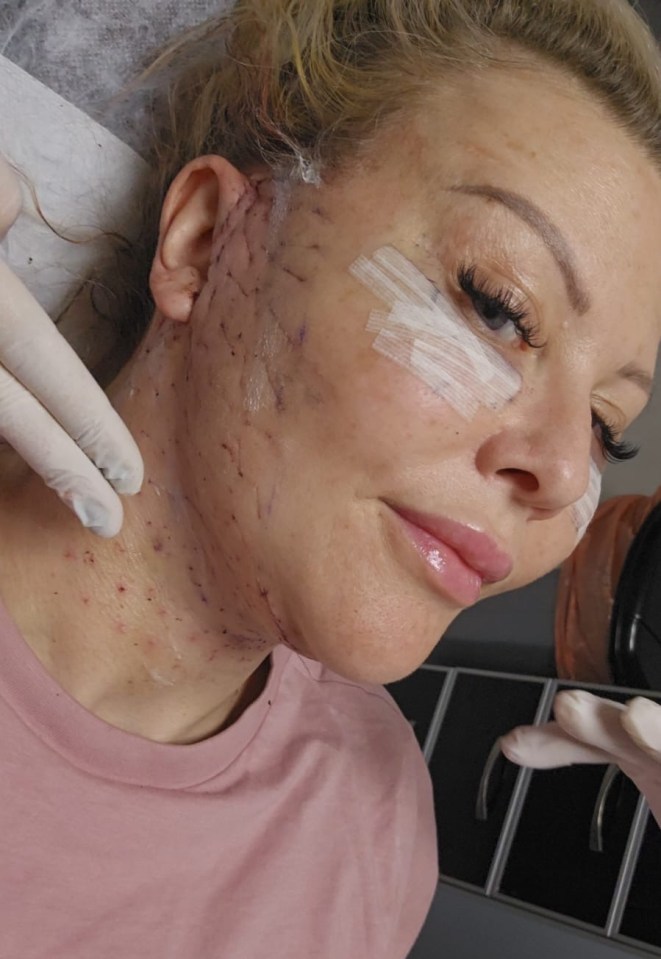 Close-up of a woman's face and neck immediately following a face and neck lift, showing stitches and bandages.