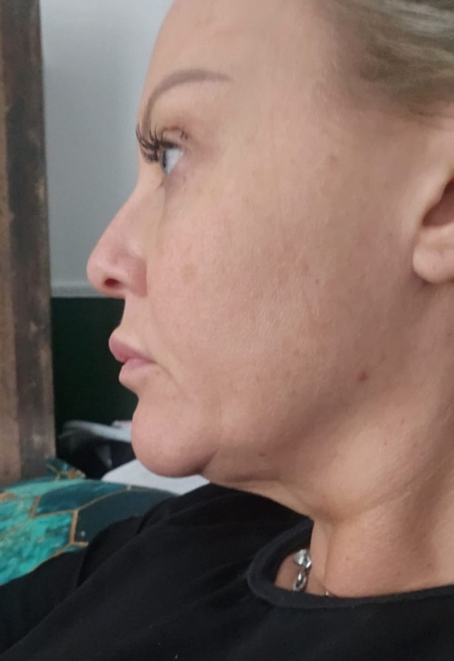 Woman's profile showing neck and face before neck lift surgery.