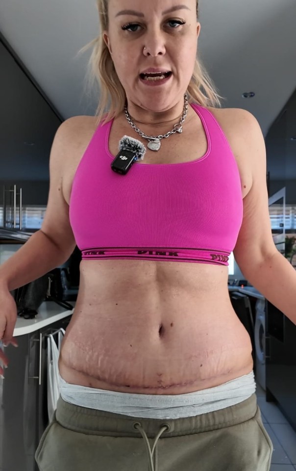 Woman showing her stomach scars after a mummy makeover.