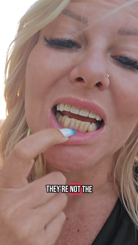 Close-up of a woman showing off her new turkey teeth.