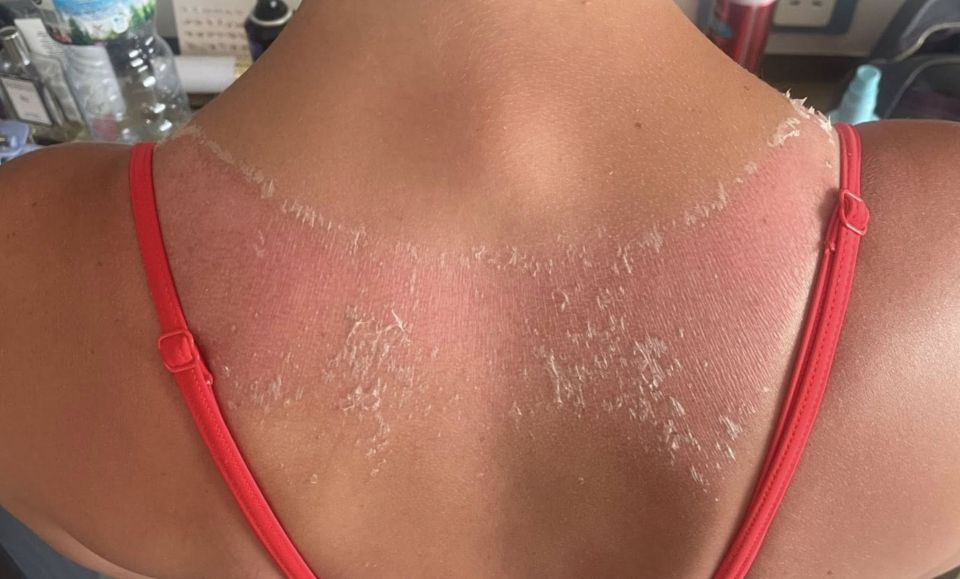 PIC FROM Kennedy News and Media (PICTURED: 25-YEAR-OLD SORAYA YOUNG'S BURN) A holidaymaker claims a tank top from Shein reacted with her sun cream - after being left with horror BURNS that she fears may cause 'nightmare scarring'. Soraya Young travelled with her boyfriend George Harris, 26, to Marmaris, Turkey, for a 12-day getaway as a break from renovating their house on July 18th. The 25-year-old had purchased a £4.99 pack of three tank tops back in April to stock up for the warmer weather and says she washed them before packing. DISCLAIMER: While Kennedy News and Media uses its best endeavours to establish the copyright and authenticity of all pictures supplied, it accepts no liability for any damage, loss or legal action caused by the use of images supplied and the publication of images is solely at your discretion. SEE KENNEDY NEWS COPY - 0161 697 4266