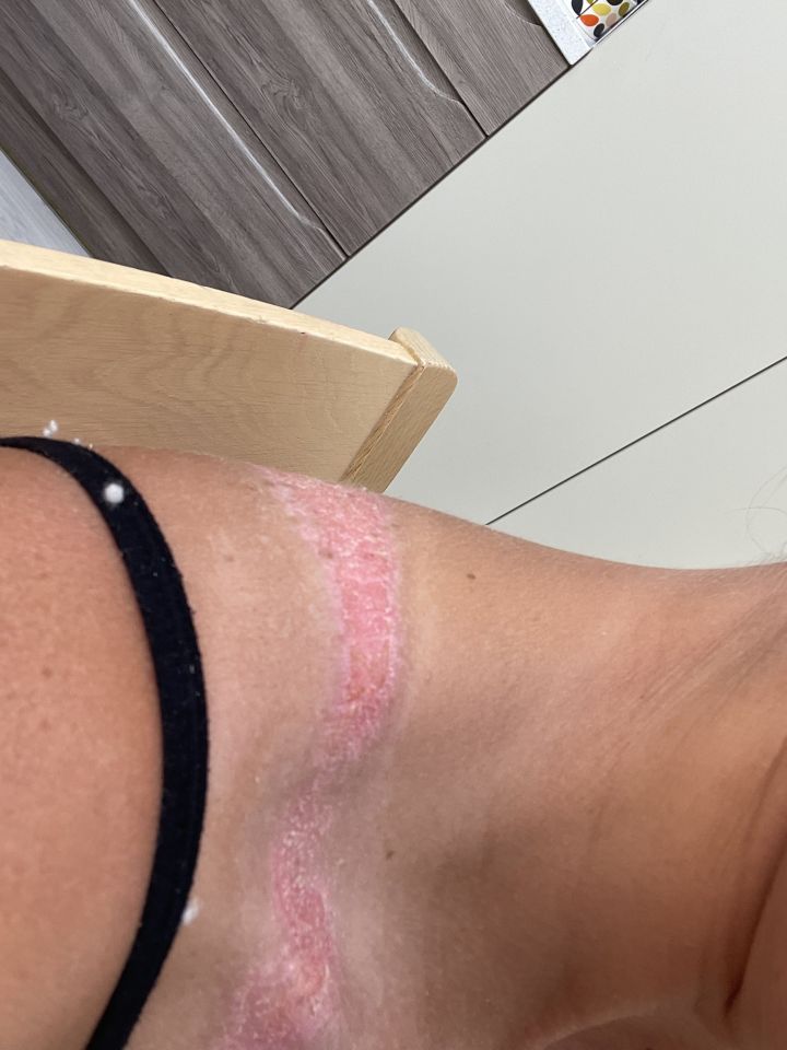 Close-up of a sunburned shoulder.