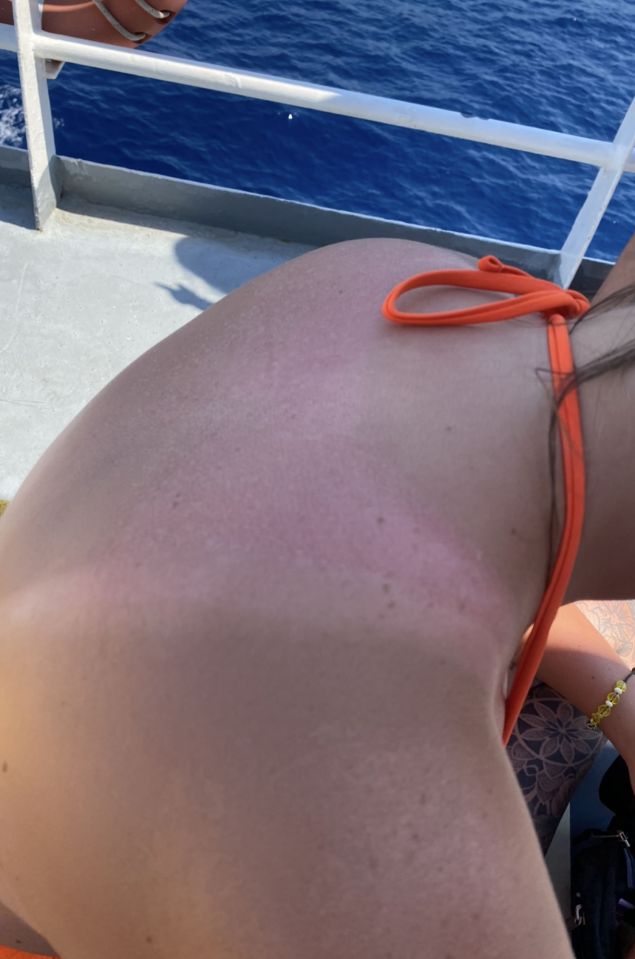 Sunburned back after wearing a Shein tank top.