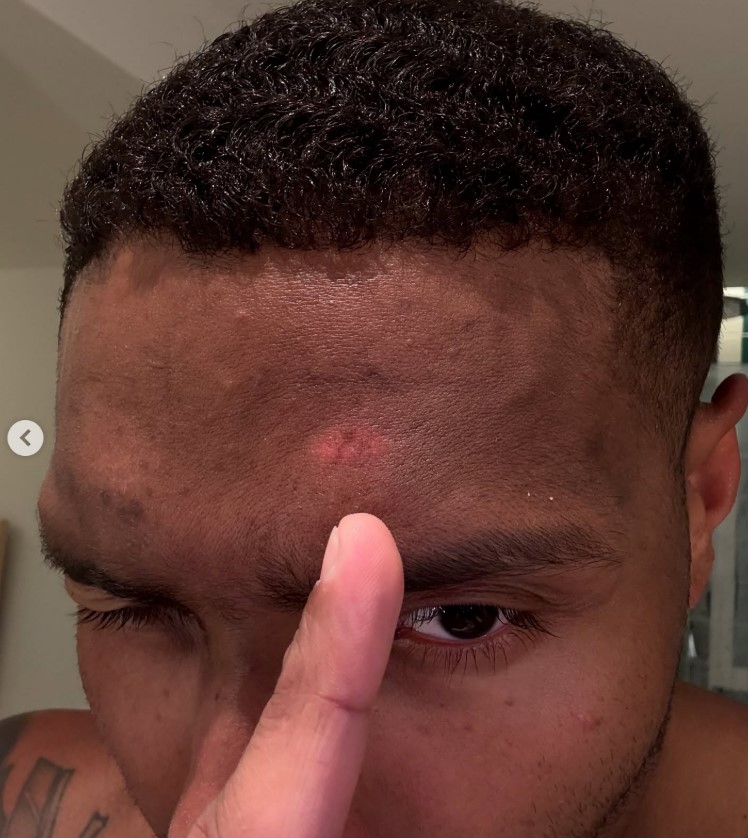 Close-up of a person's forehead pointing to a small, red mark.
