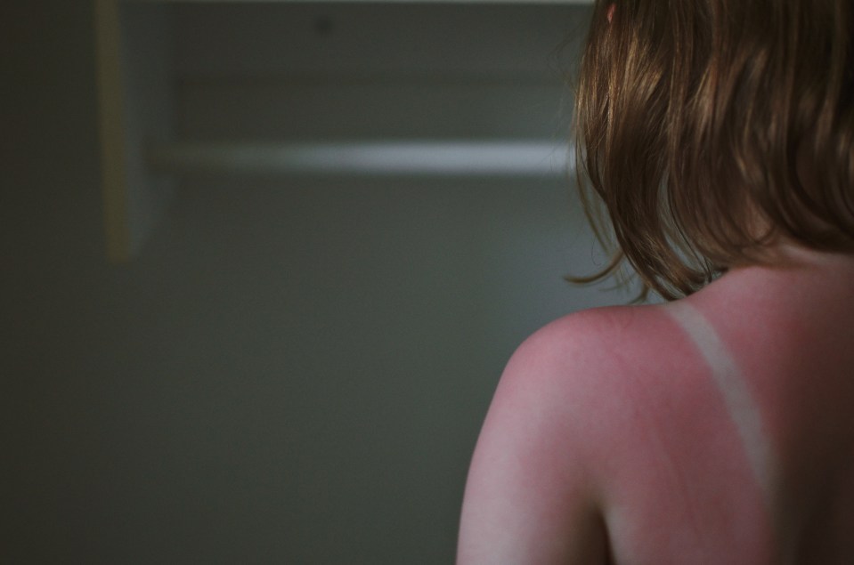 Woman's sunburned back.