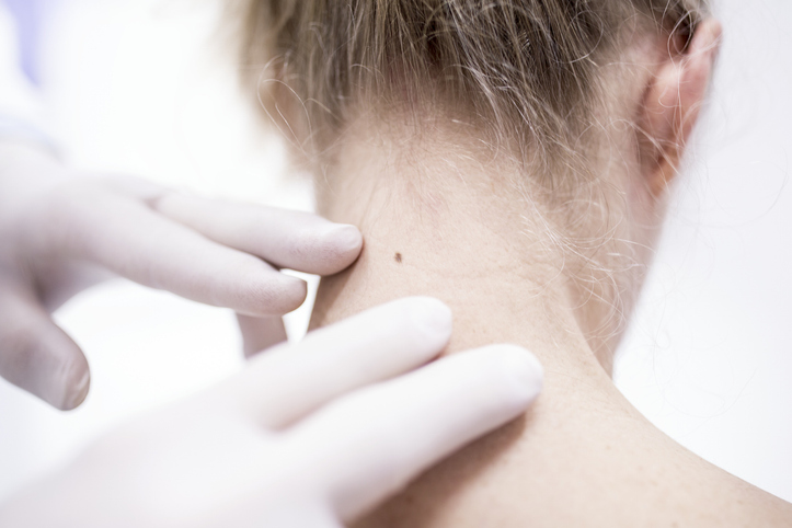 Doctor examining a mole on a patient's neck.
